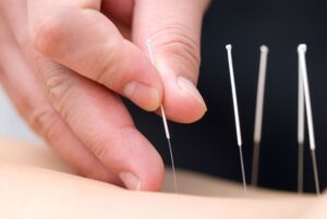 weight management acupuncture