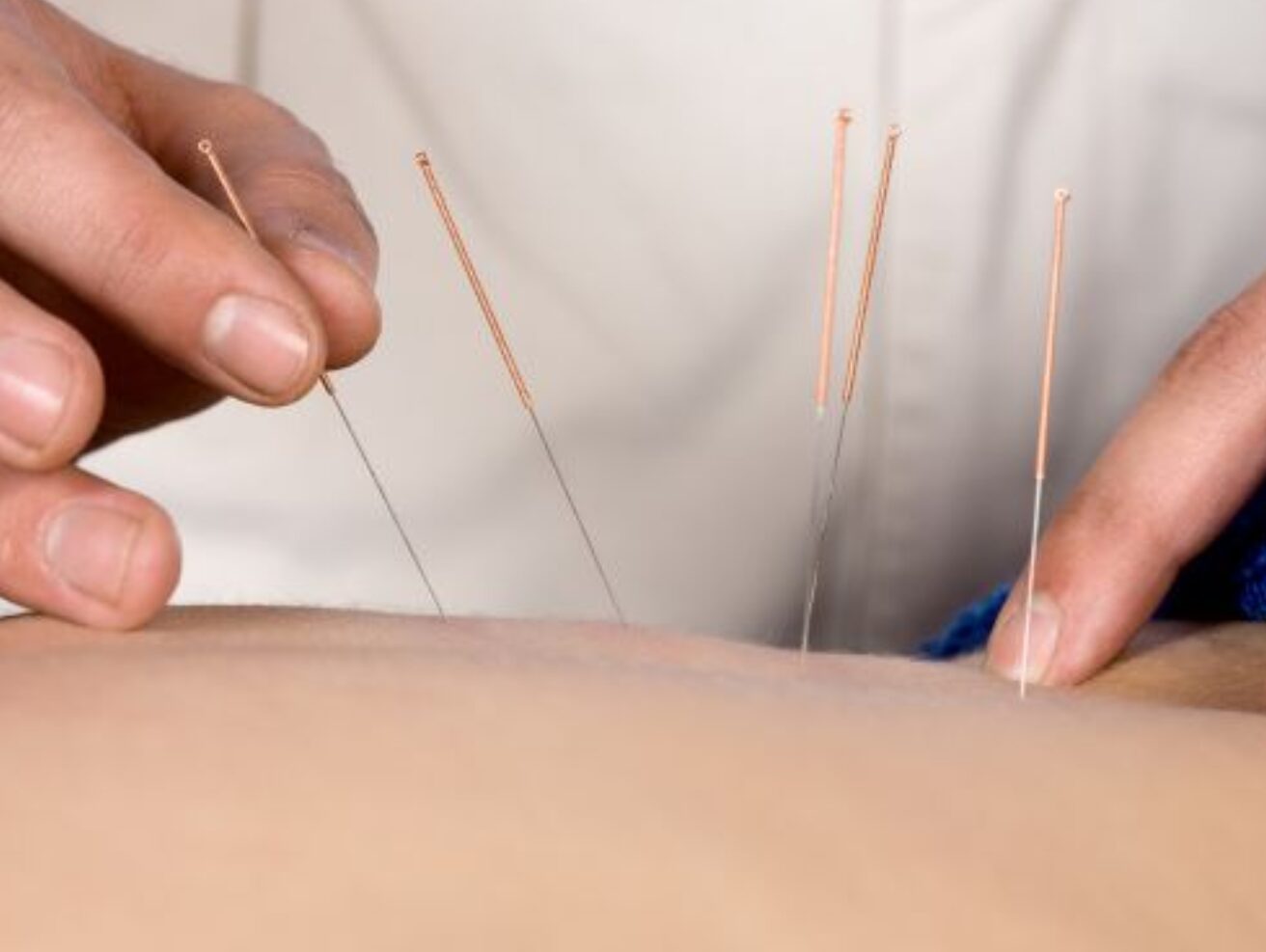 Acupuncture