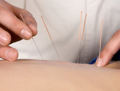 Acupuncture